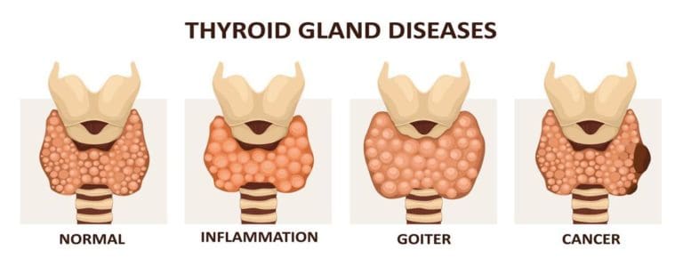 why-do-i-have-thyroid-nodules-rfa-for-life-blog