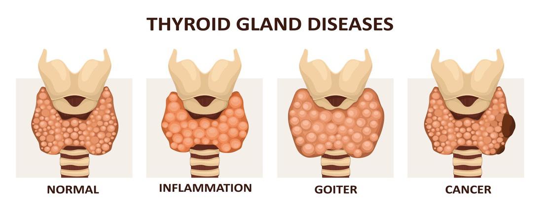 hyperplasia of thyroid gland