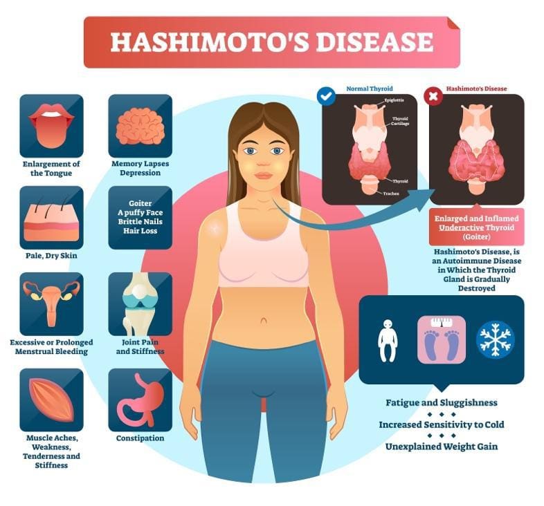 Hashimoto's Hidden Link - Exploring the Gut-Thyroid Connection