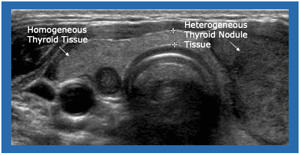 Ultrasound Thyroiditis