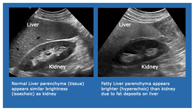 normal-vs-fatty-liver-ultrasound