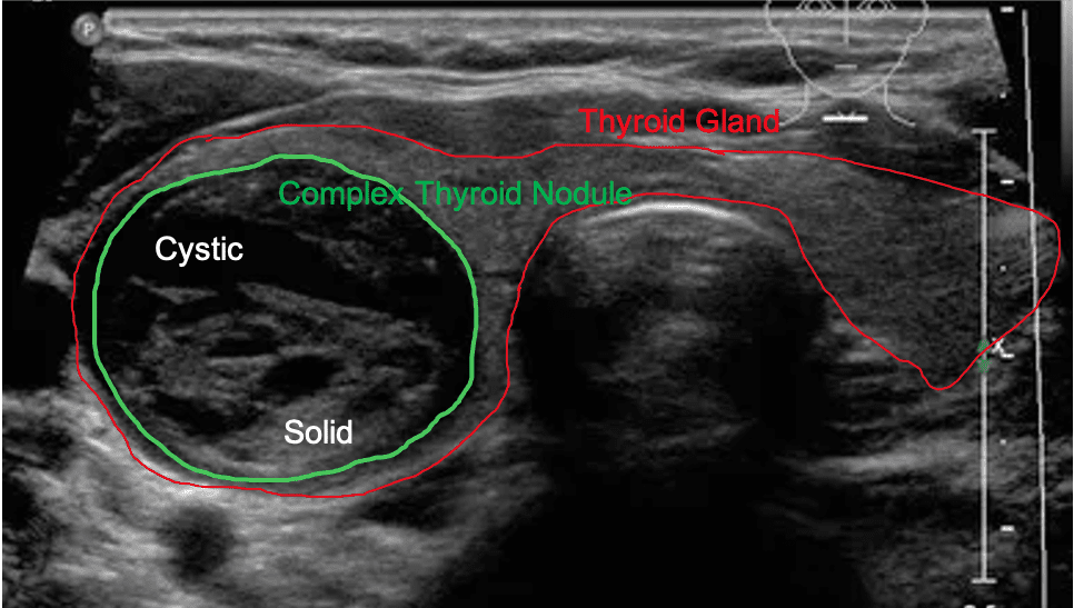 Thyroid Ultrasound Anatomy Thyroid Ultrasound Anatomy