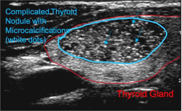 complicated thyroid