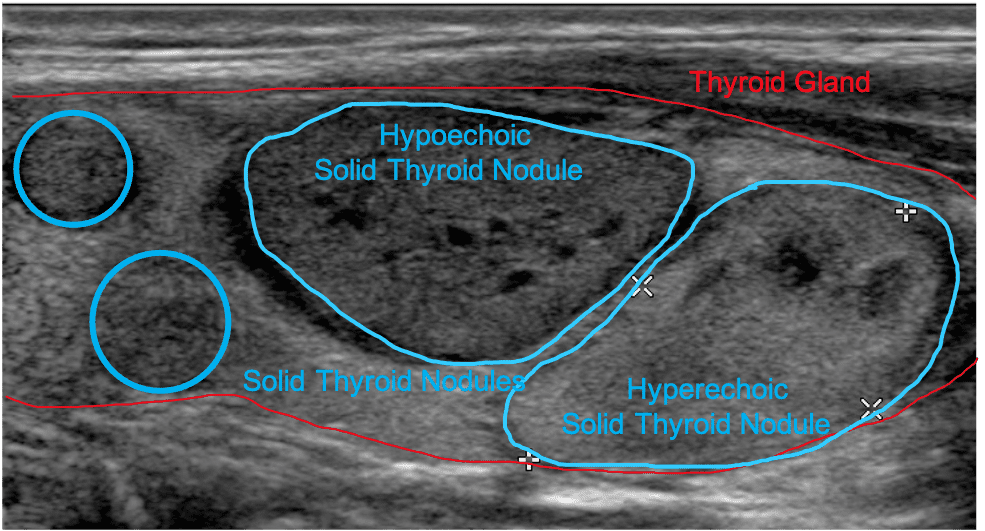 soild thyroid