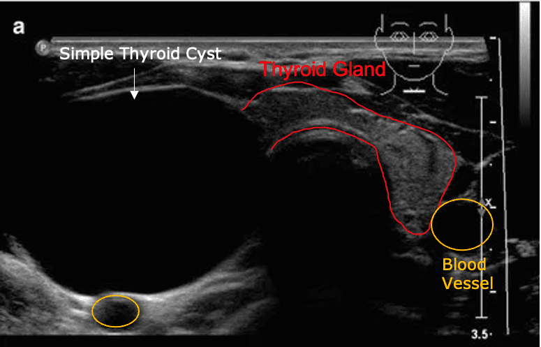 thyroid cyst