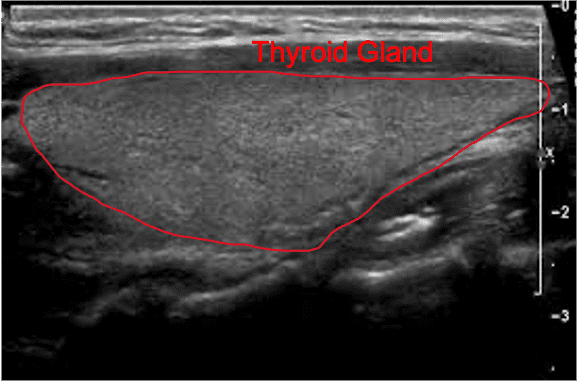 Normal Thyroid Gland Ultrasound Normal Thyroid Gland Ultrasound